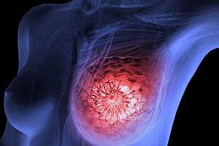 Рак груди – профилактика всегда предпочтительнее, чем лечение (фото)